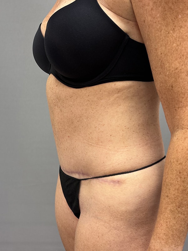 Liposuction Before & After Image
