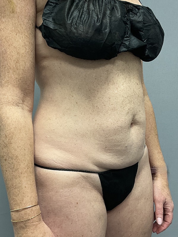 Liposuction Before & After Image