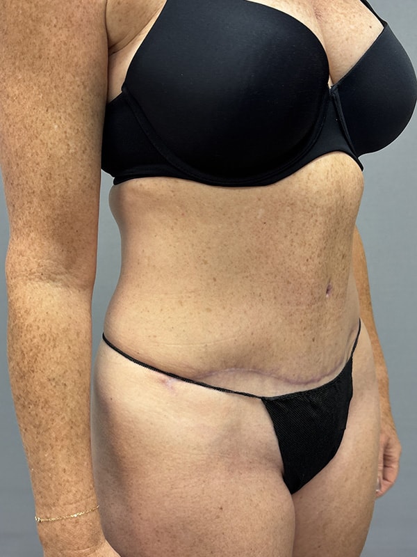Liposuction Before & After Image