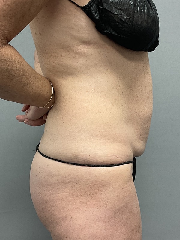 Liposuction Before & After Image
