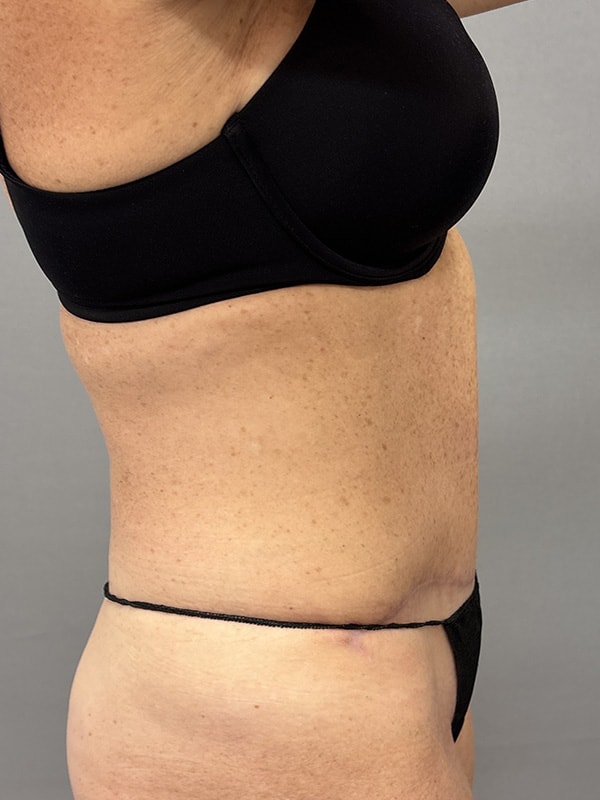 Liposuction Before & After Image