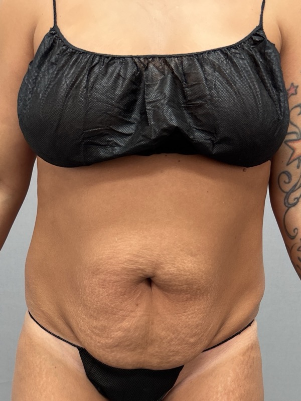 Liposuction Before & After Image