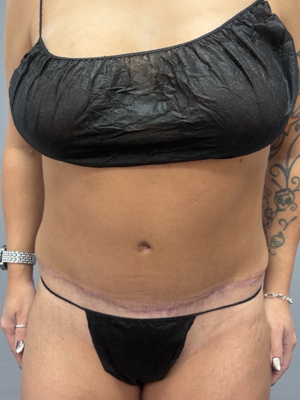 Liposuction Before & After Image