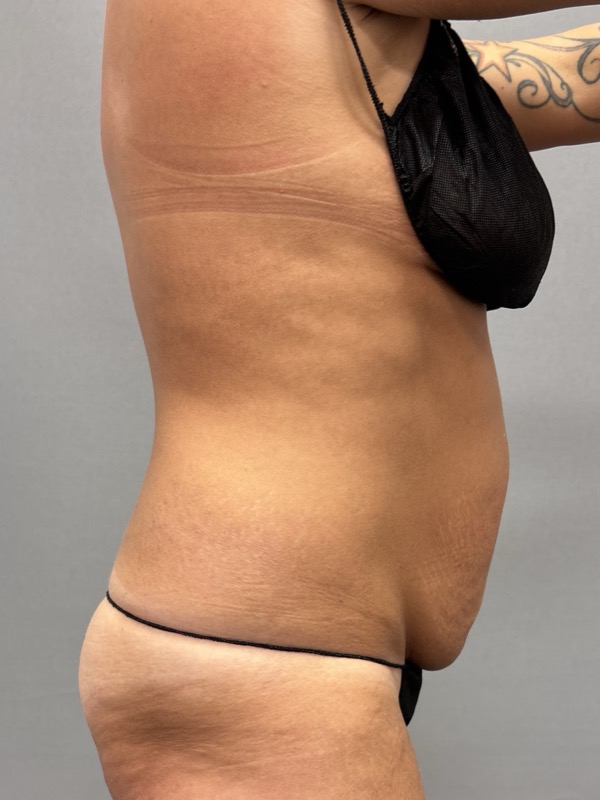 Liposuction Before & After Image