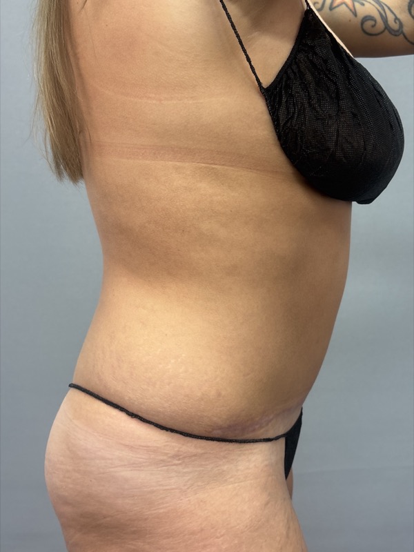 Liposuction Before & After Image