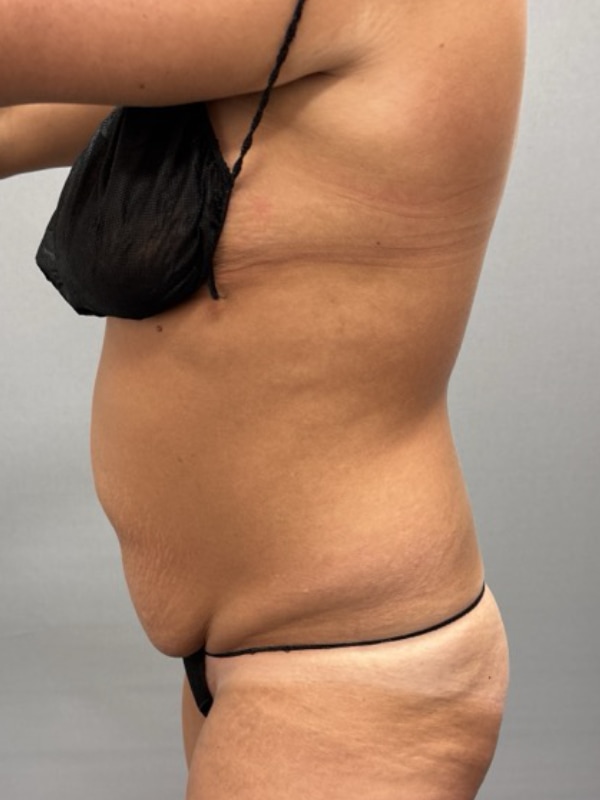 Liposuction Before & After Image