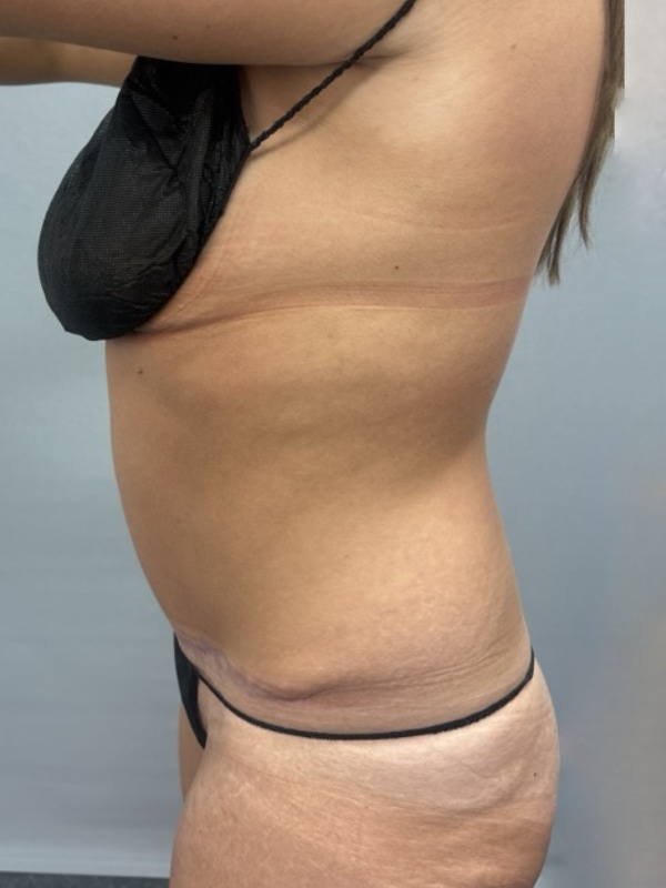Liposuction Before & After Image