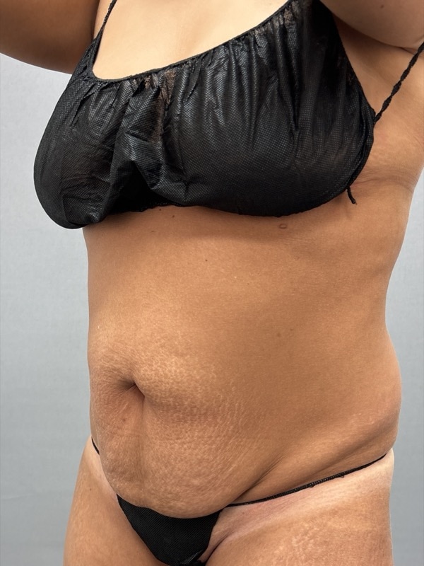 Liposuction Before & After Image