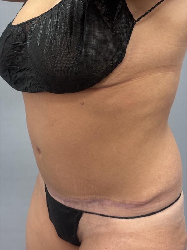 Liposuction Before & After Image