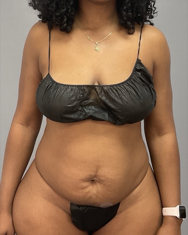 Liposuction Before & After Image