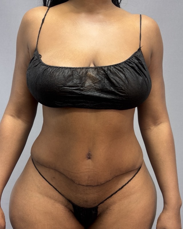 Liposuction Before & After Image