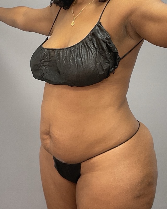 Liposuction Before & After Image