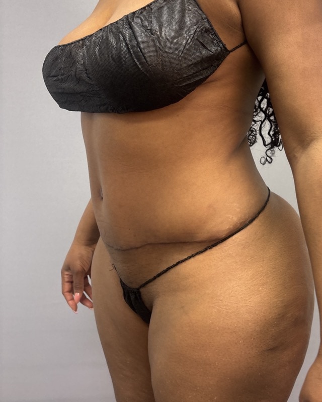 Liposuction Before & After Image