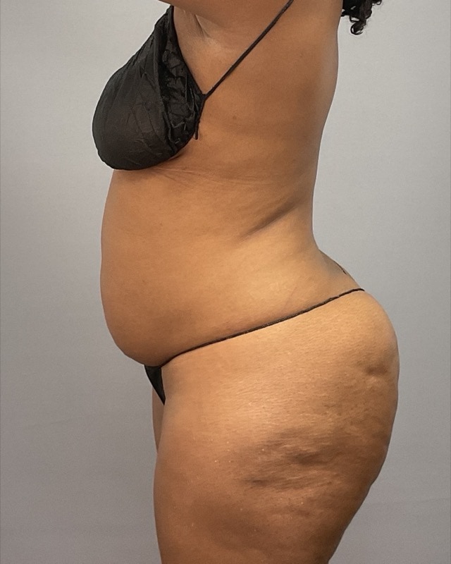 Liposuction Before & After Image