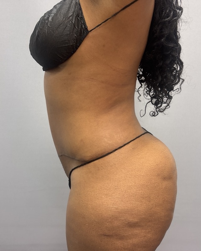 Liposuction Before & After Image