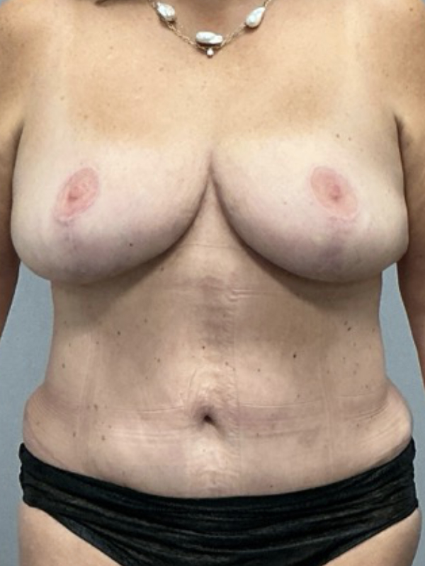 Liposuction Before & After Image