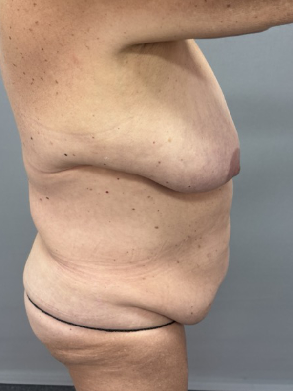 Liposuction Before & After Image