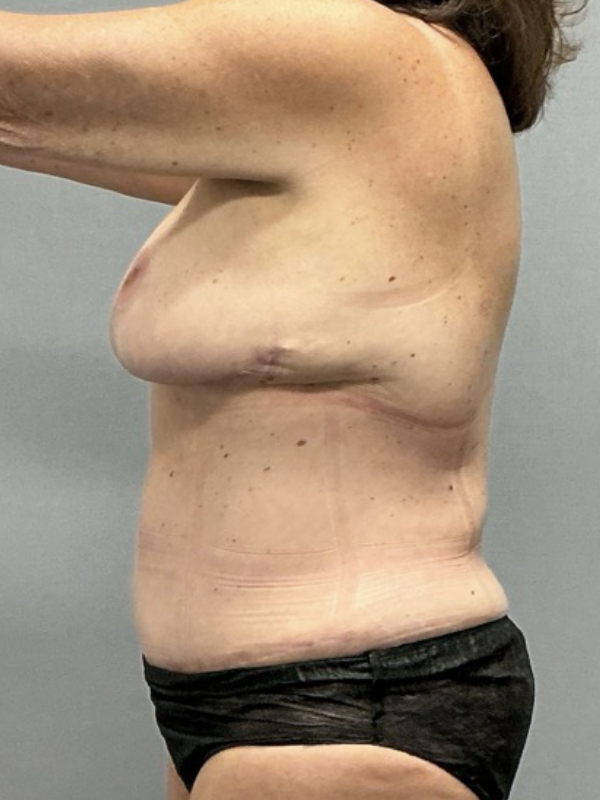 Liposuction Before & After Image