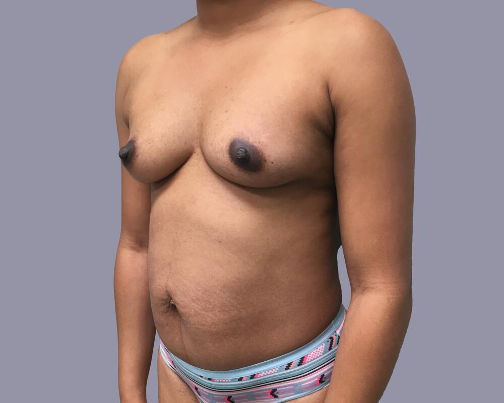 Mommy Makeover Before & After Image