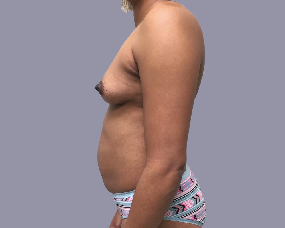 Mommy Makeover Before & After Image