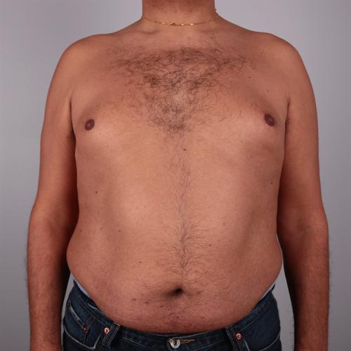 Tummy Tuck Before & After Image