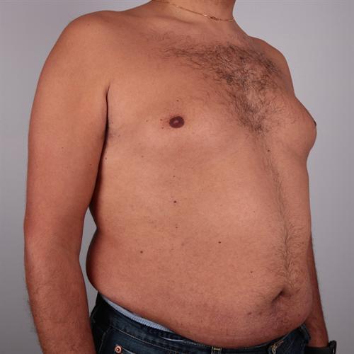 Tummy Tuck Before & After Image