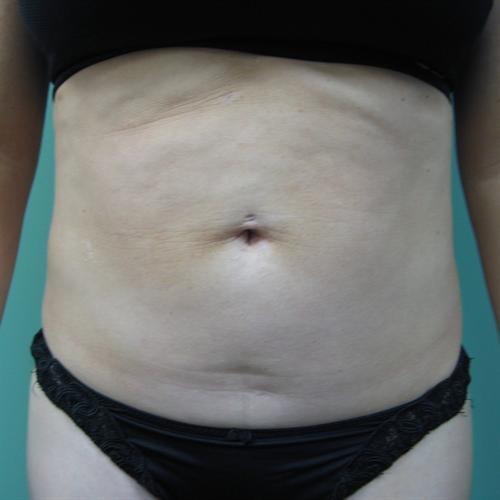 Tummy Tuck Before & After Image