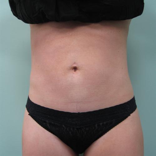 Tummy Tuck Before & After Image