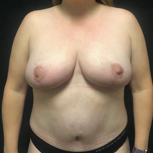 Tummy Tuck Before & After Image