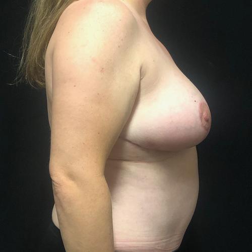 Tummy Tuck Before & After Image