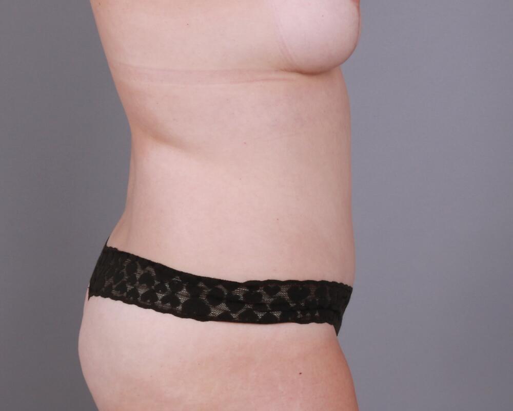 Tummy Tuck Before & After Image