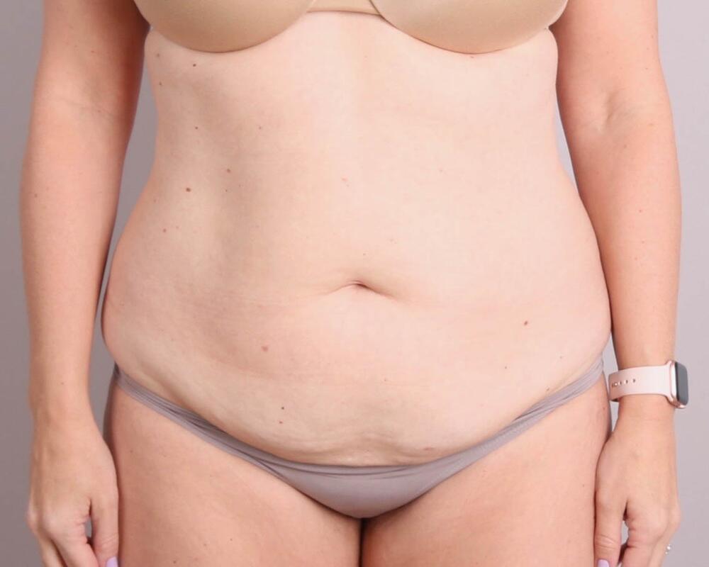 Tummy Tuck Before & After Image