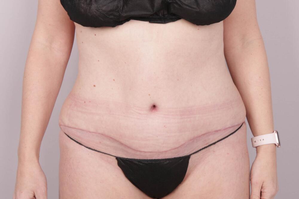 Tummy Tuck Before & After Image