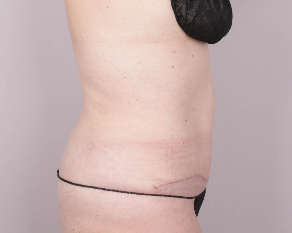 Tummy Tuck Before & After Image