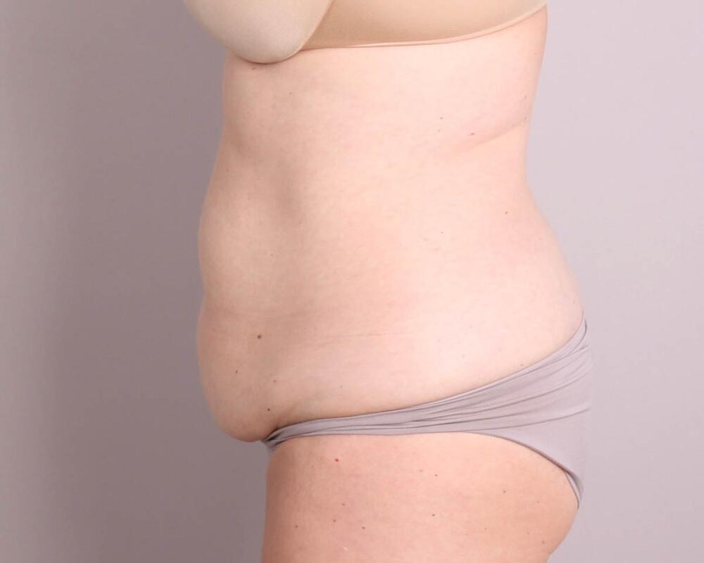 Tummy Tuck Before & After Image