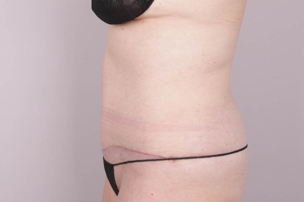 Tummy Tuck Before & After Image