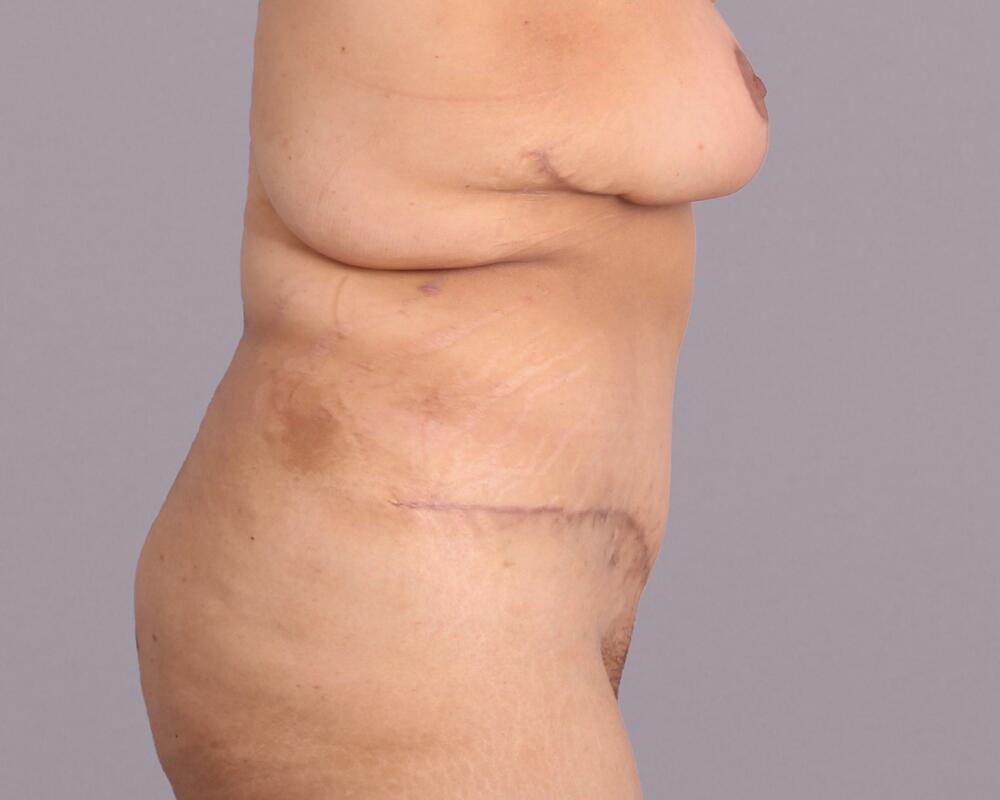 Tummy Tuck Before & After Image