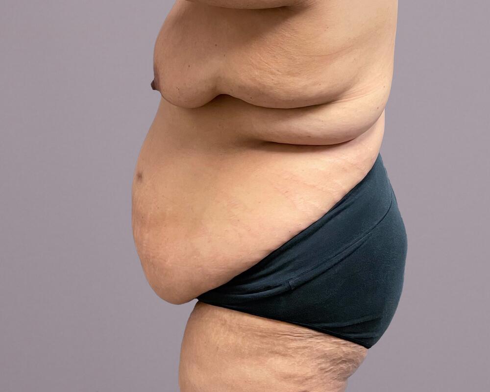 Tummy Tuck Before & After Image