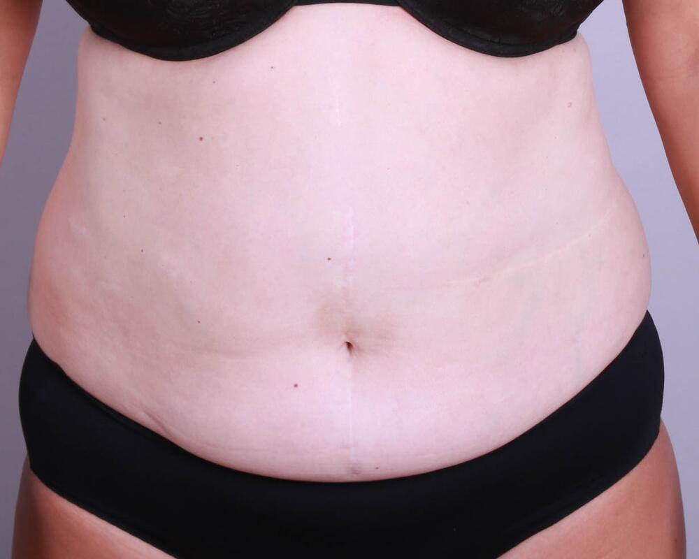 Tummy Tuck Before & After Image