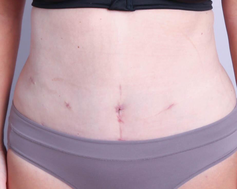 Tummy Tuck Before & After Image