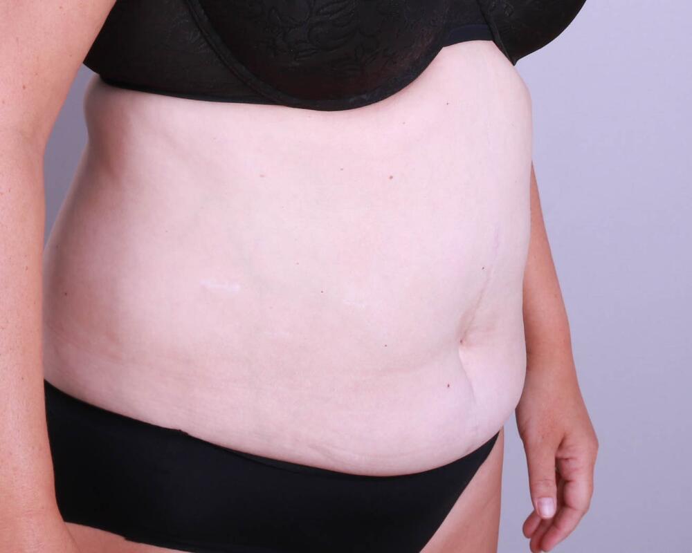 Tummy Tuck Before & After Image