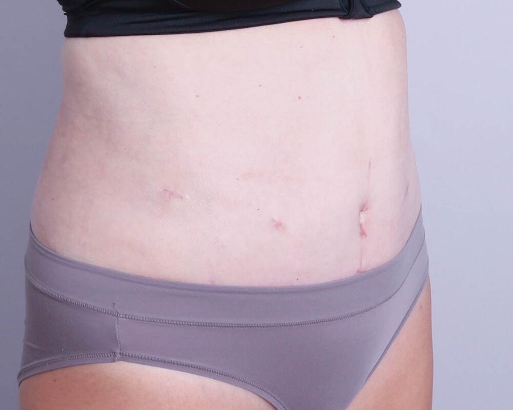 Tummy Tuck Before & After Image