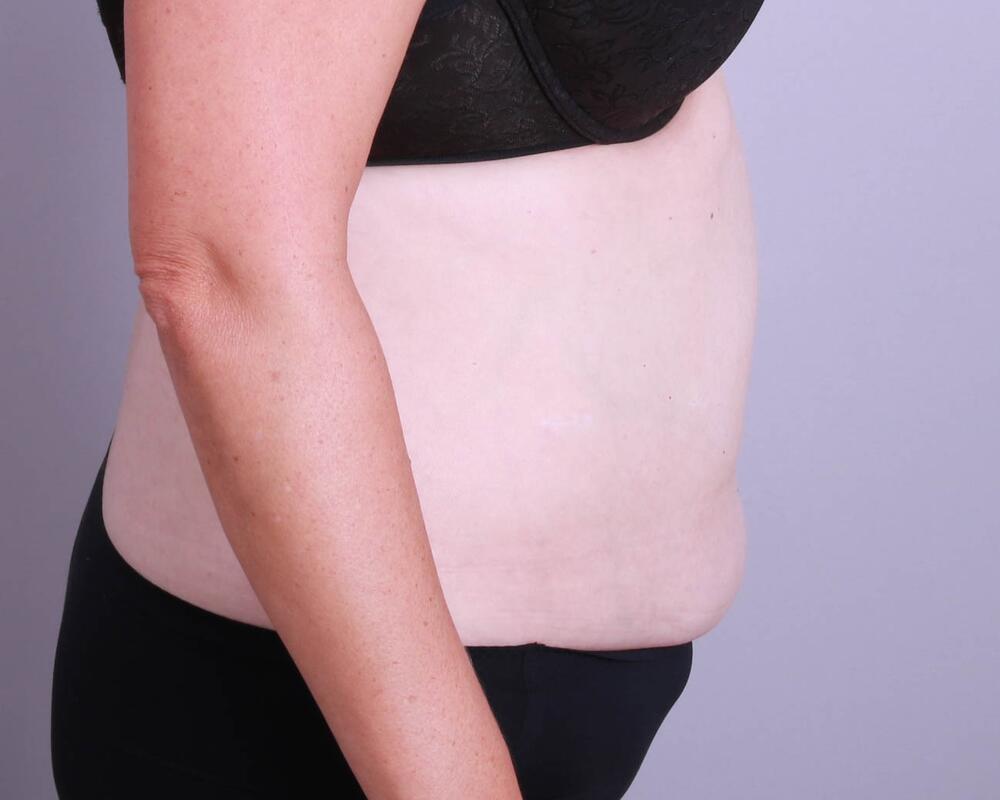 Tummy Tuck Before & After Image