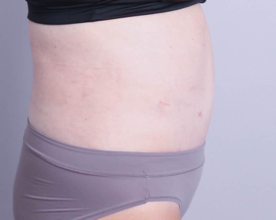 Tummy Tuck Before & After Image