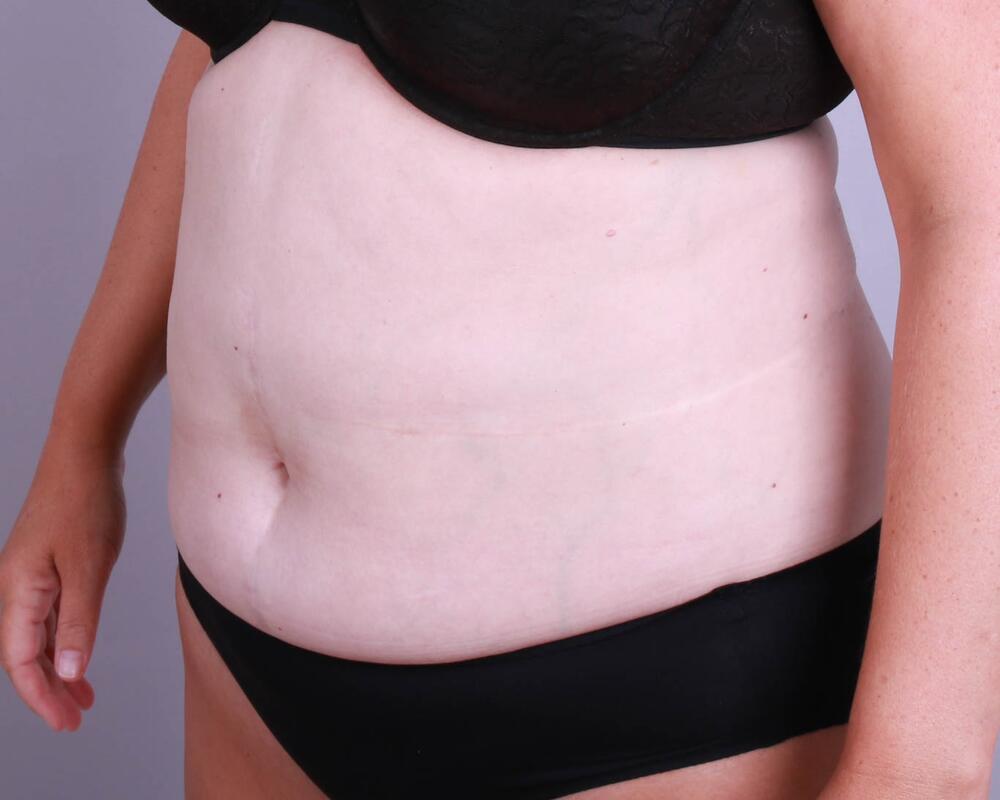 Tummy Tuck Before & After Image