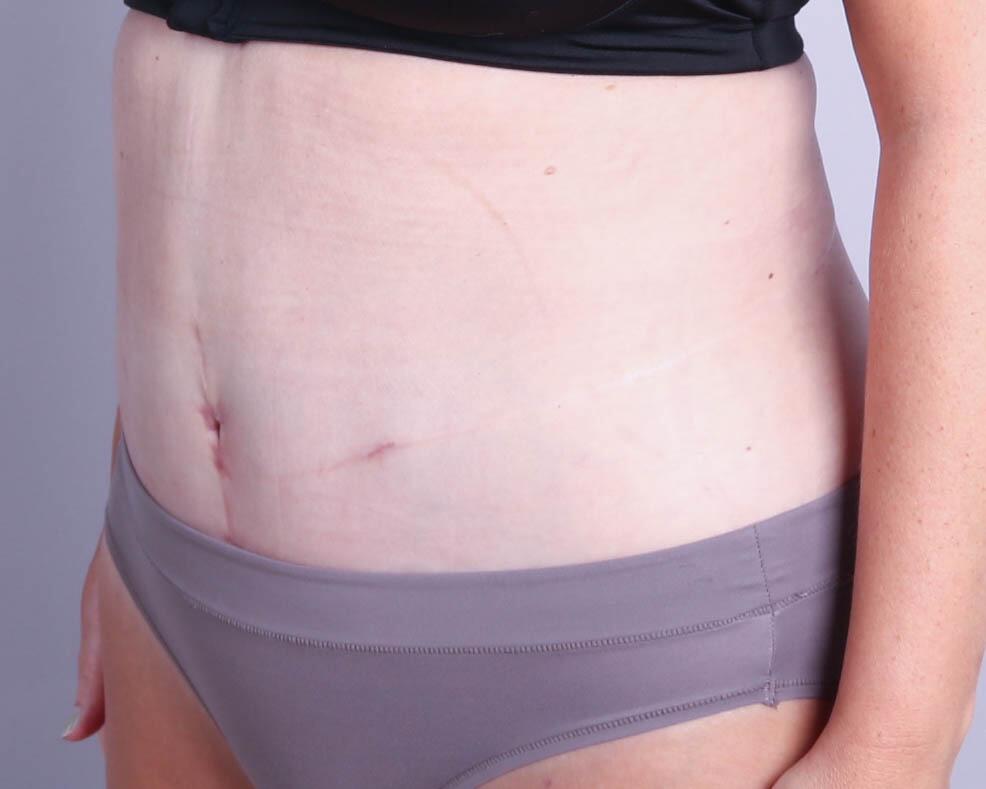 Tummy Tuck Before & After Image