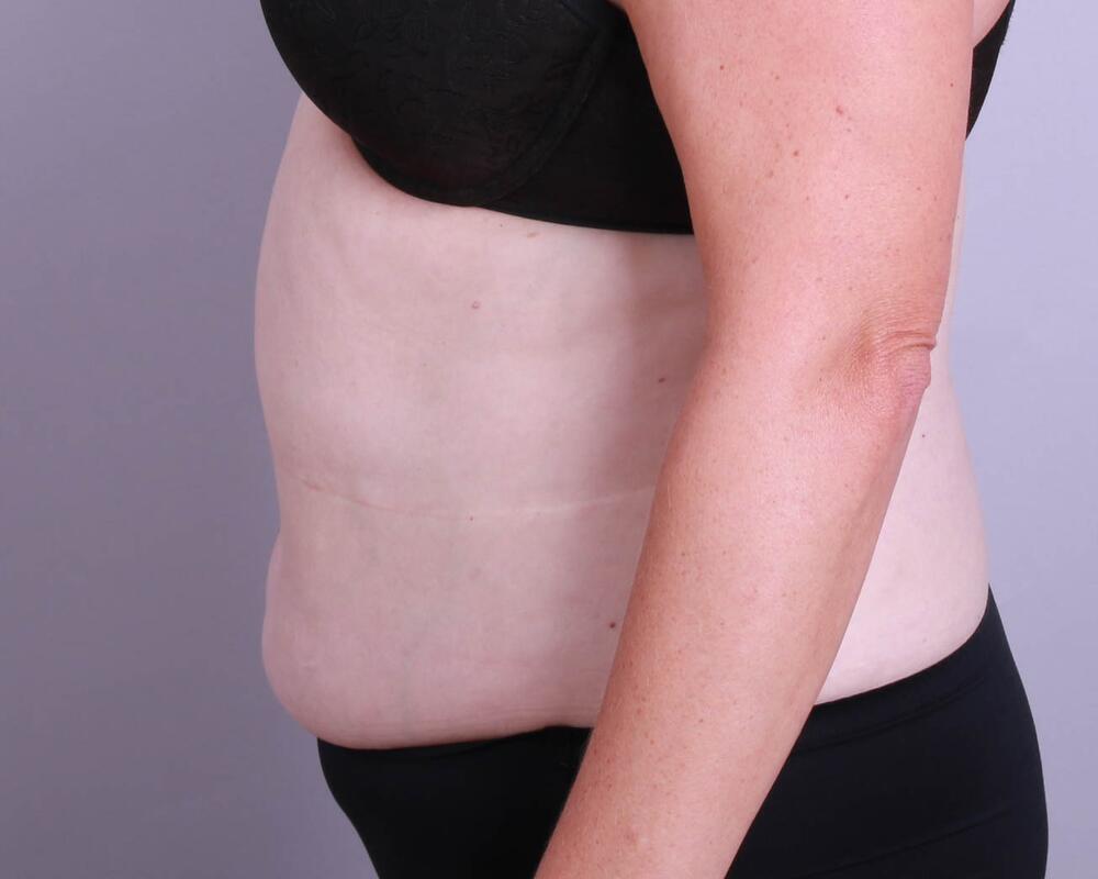 Tummy Tuck Before & After Image