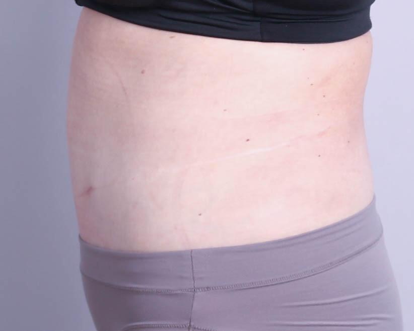 Tummy Tuck Before & After Image