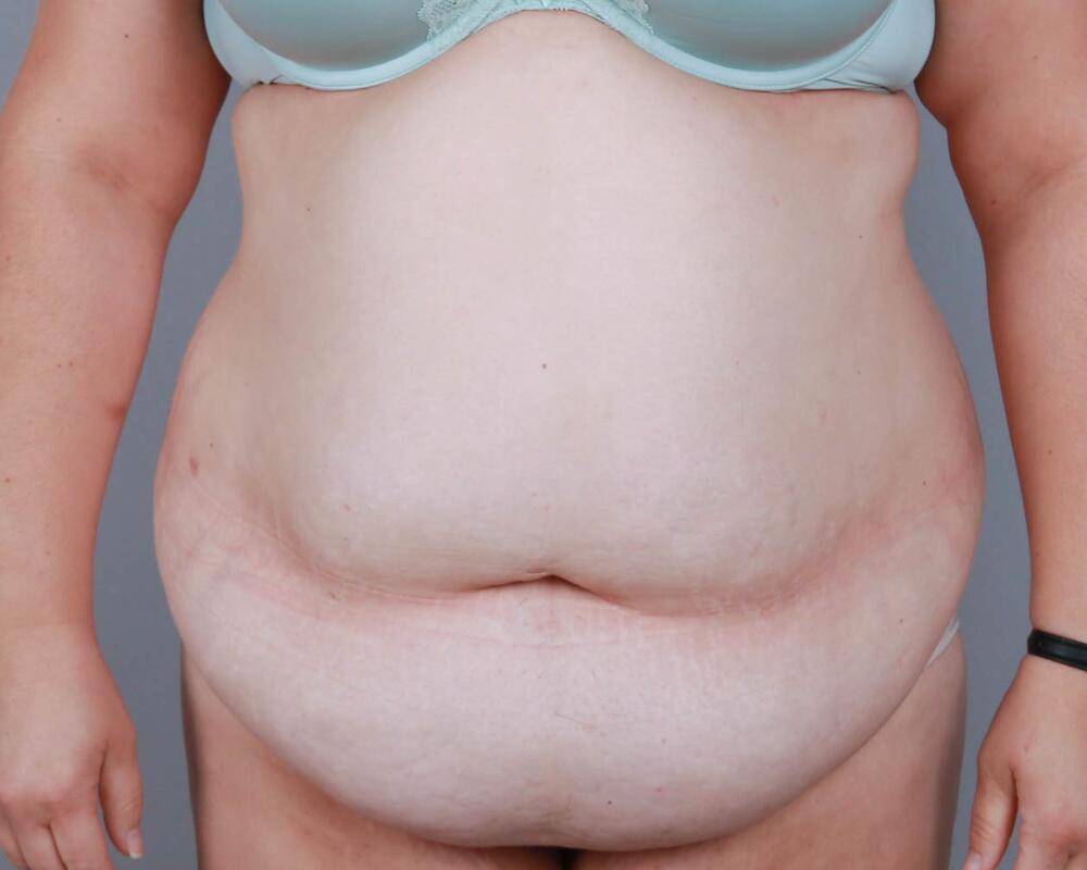 Tummy Tuck Before & After Image