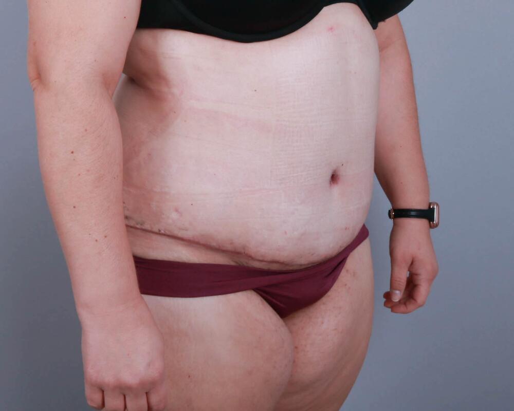 Tummy Tuck Before & After Image